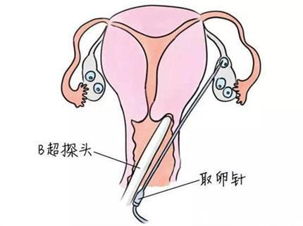 试管婴儿自然周期取卵，探索现代生育技术的自然之路