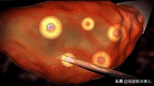 取卵后剧痛，一种生理挑战与心理应对